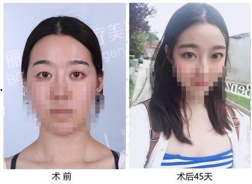 埋线拆线视频,一图看懂埋线拆线全过程